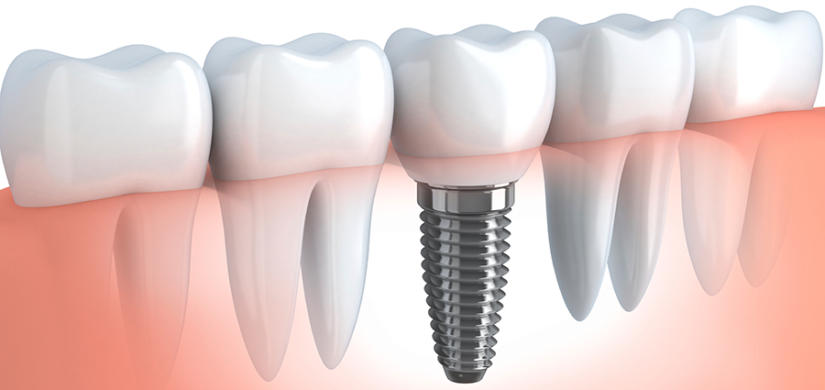 dental-implants-med3